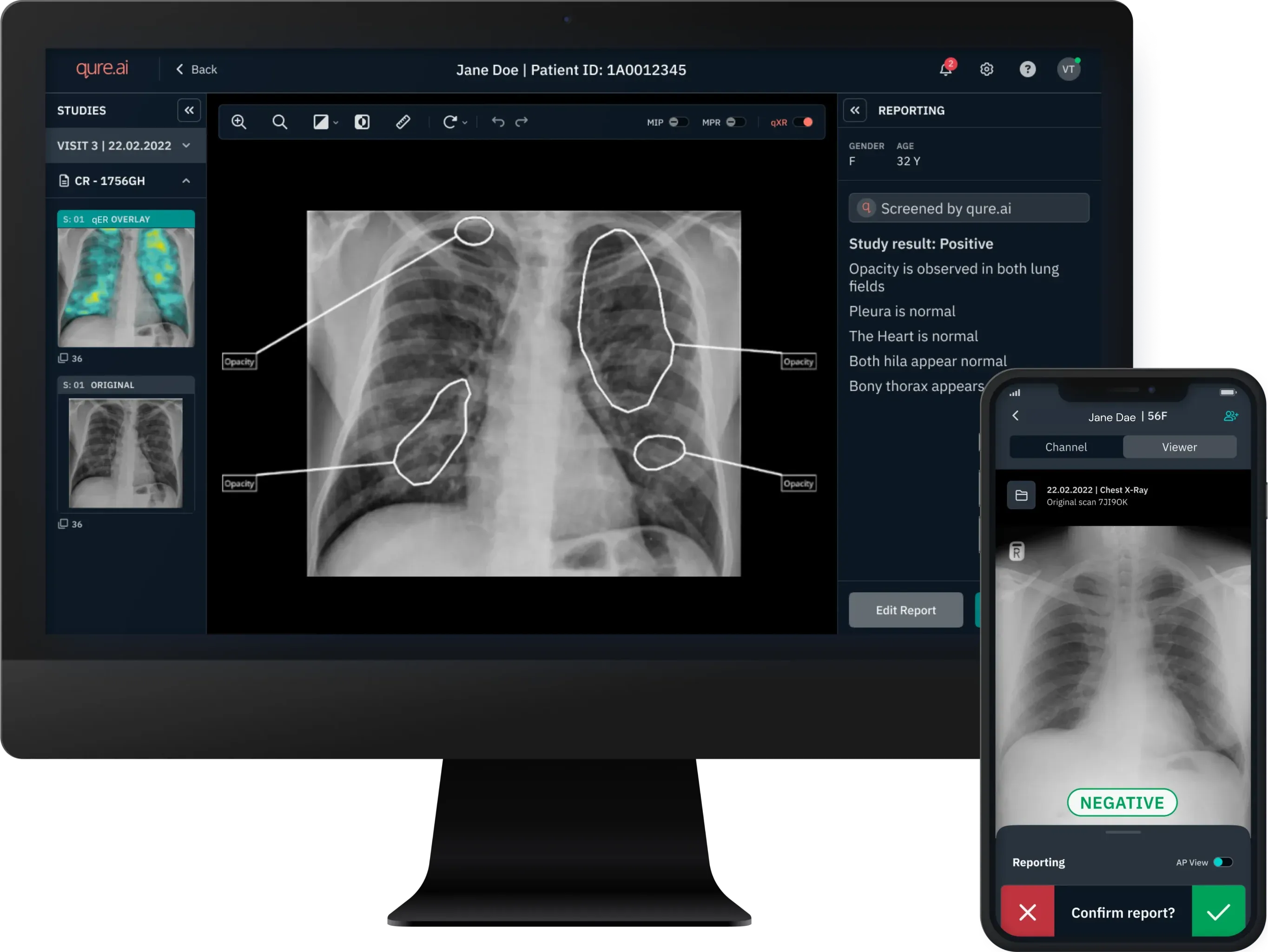 Chest_X_ray_reporting_747c180b0e.webp