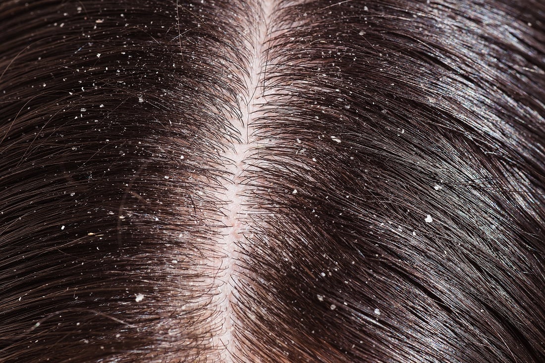 Dandruff.jpg